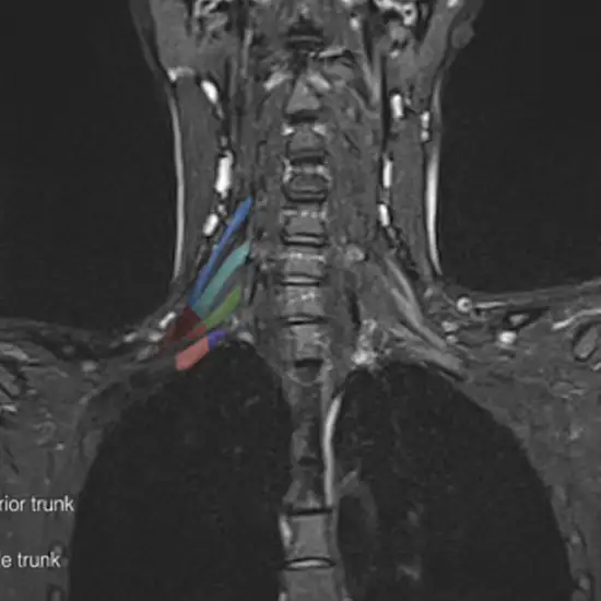 MRI Brachial Plexus